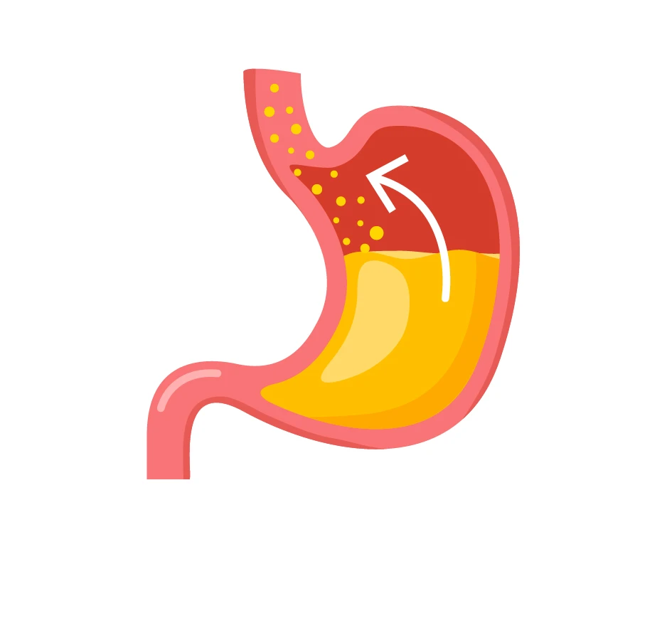 Ilustración de un estómago con reflujo gastroesofágico.