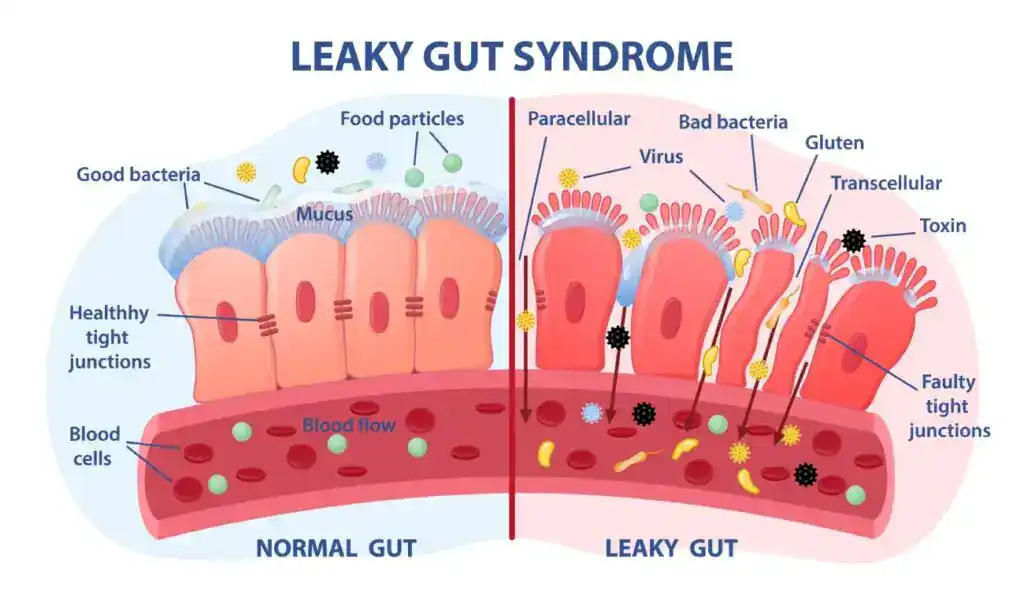 Ilustración de un intestino sano y uno permeable, con uniones estrechas dañadas y toxinas que pasan a la sangre.